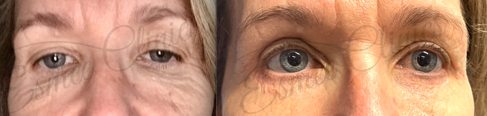 Before and After img